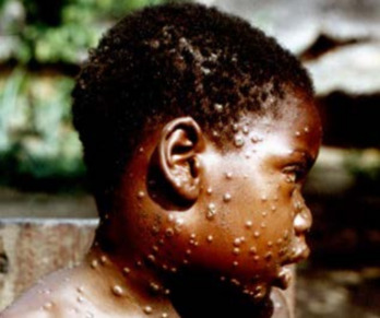 Efectos de la viruela del mono, una enfermedad endémica en Africa.